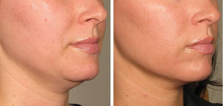 Premium Skin Tightening – Face & Neck